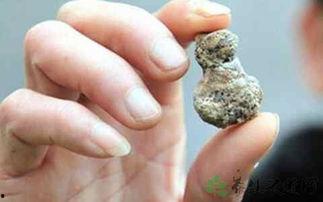 结石可以吃瓜,巧吃瓜果，轻松排石